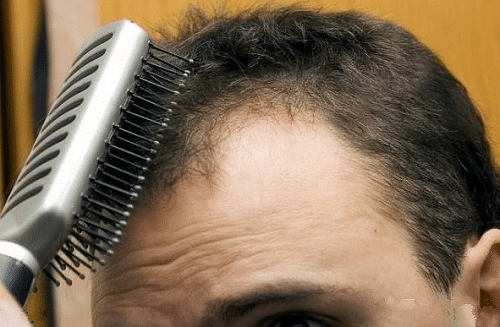 脱发老十岁,年轻人脱发该怎么办