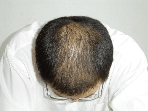 杭州新生植发:脱发前会有这些症状,看看你中招