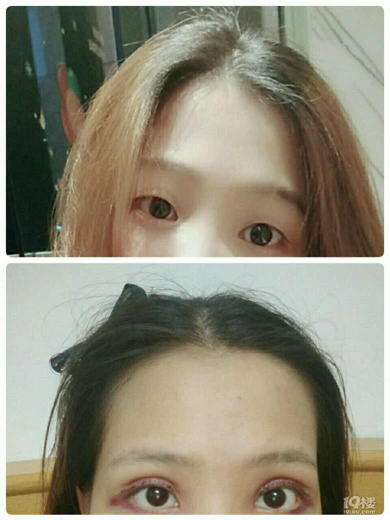 【微整日记】无痕双眼皮第53天