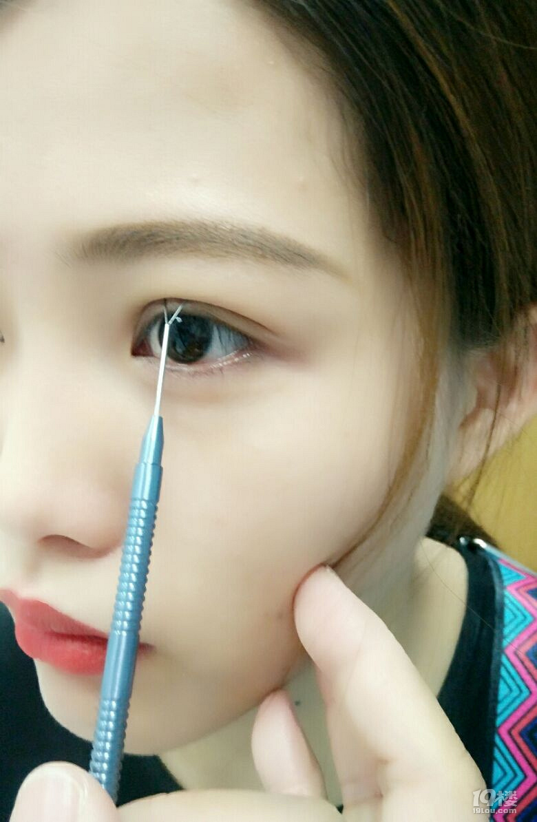 【微整日记】无痕双眼皮第53天