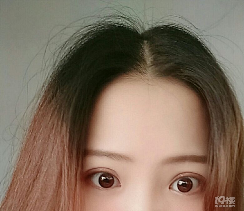 【微整日记】无痕双眼皮第53天