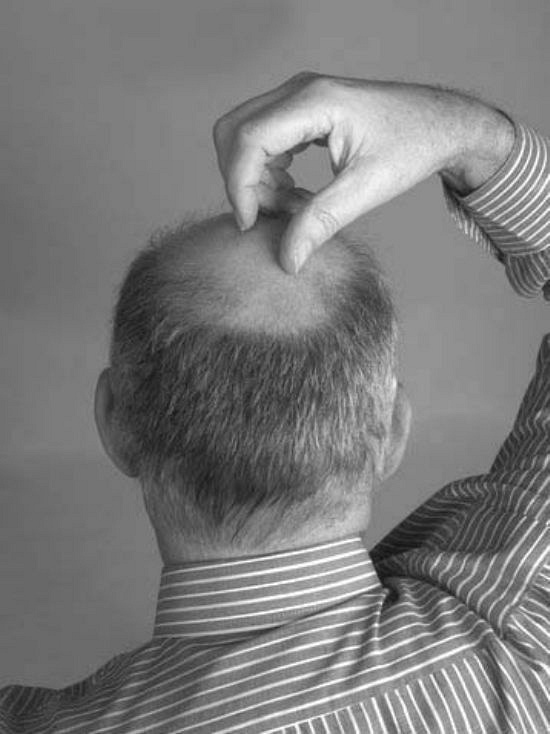 头发加密需要剃头吗?不剃光头可以吗?