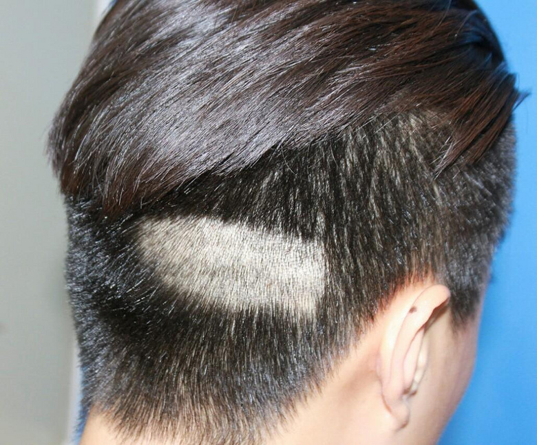 植发,为什么偏偏选中后枕部来取毛囊呢?