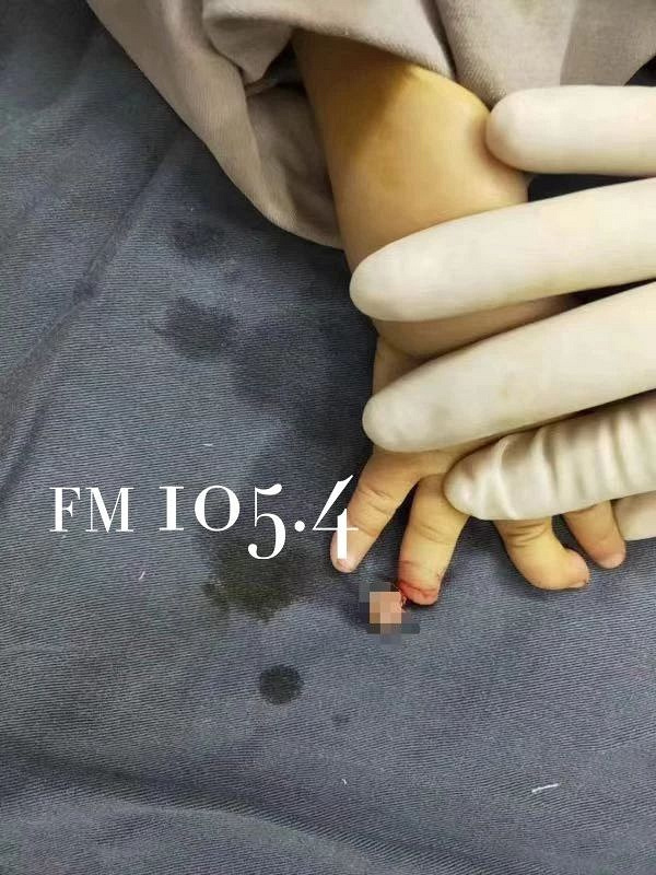 18个月女婴手指被兔子一口咬断!兔兔那么可爱,什么时候会咬人