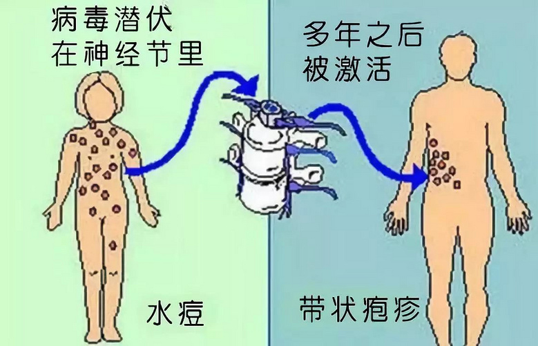 水痘的主要传播途径图片