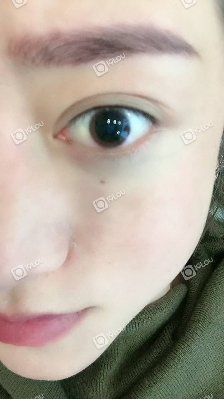 纹美瞳线商家操作不当划伤眼角膜商家事后居然不认账