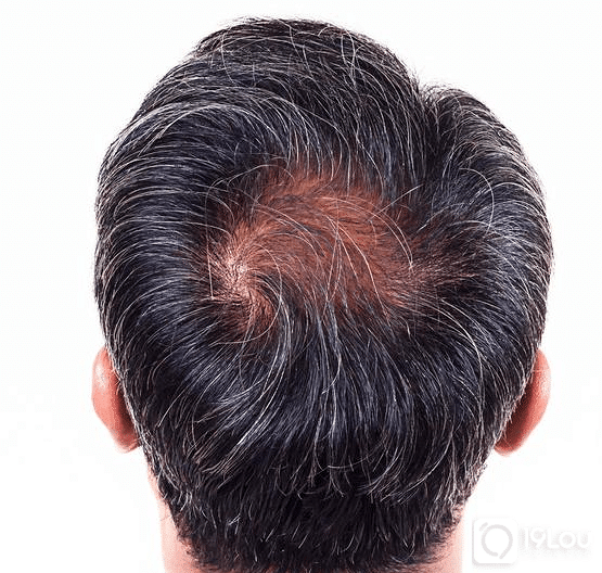 植发提取后枕部毛囊,后面不是没头发了吗?