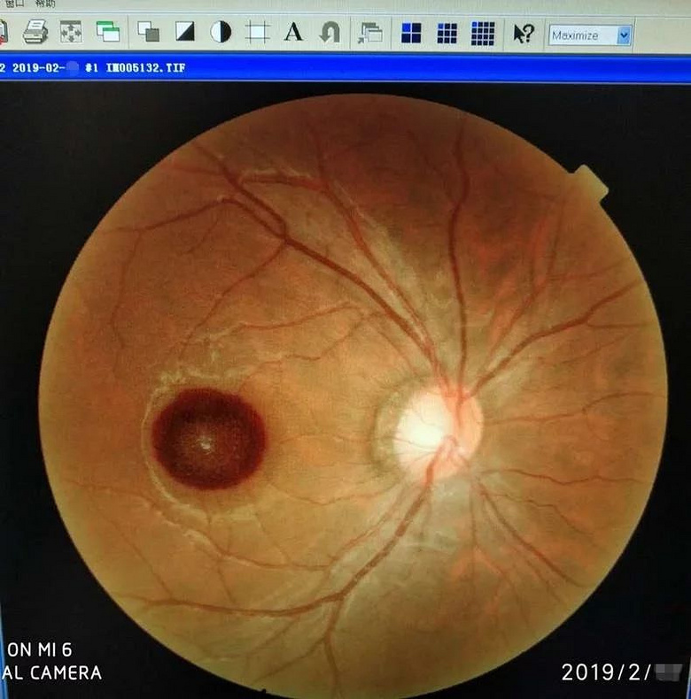 90后杭州老爸送儿子礼物,却让自己瞬间失明,终身难恢复!这东