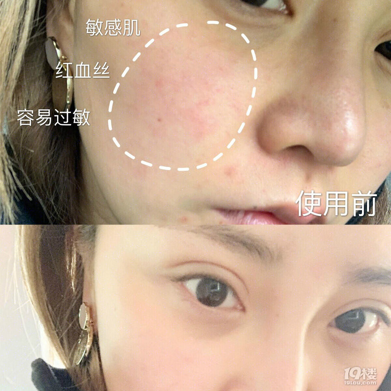 混皮常干燥过敏泛红应该如何解决？