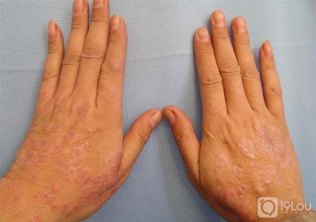 哈尔滨能治疗银屑病的医院哪家好呢