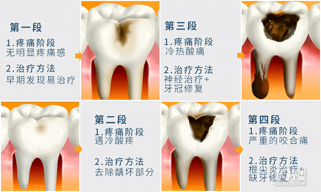 补牙后能维持多久？