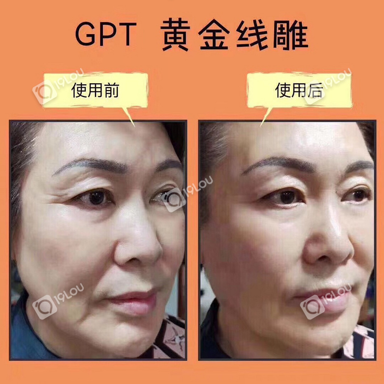 gpt黄金线雕多少钱效果如何呢gpt黄金线雕代理怎么做