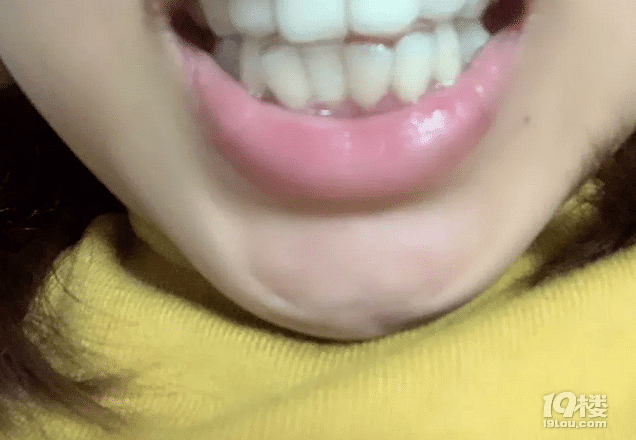 【隐形牙套日记】时代天使和隐适美的区别有多大？30岁女生侧颜杀