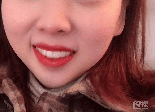 【隐形牙套日记】时代天使和隐适美的区别有多大？30岁女生侧颜杀