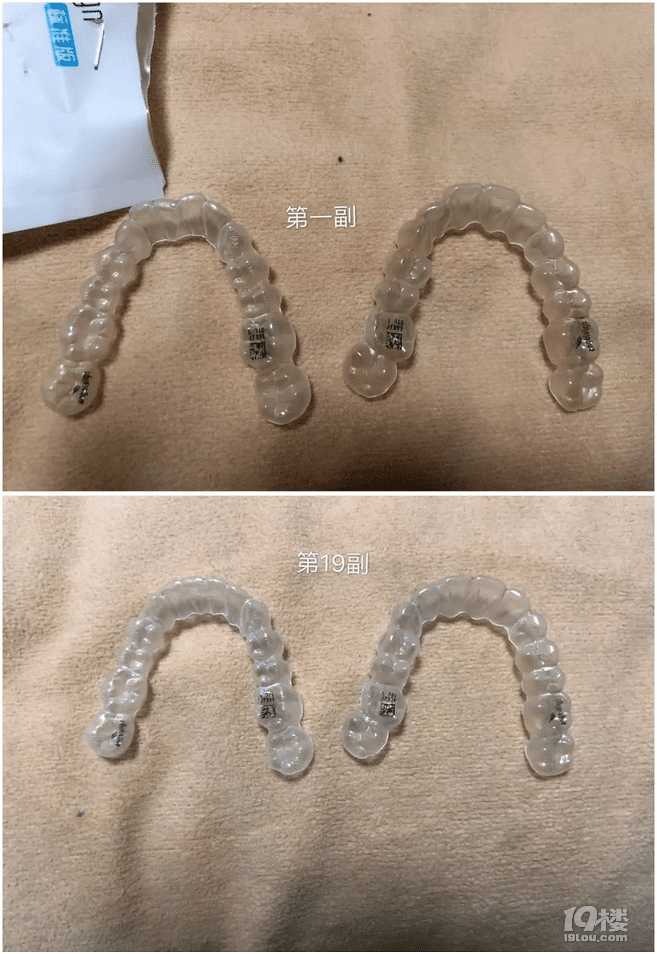 【隐形牙套日记】时代天使和隐适美的区别有多大？30岁女生侧颜杀