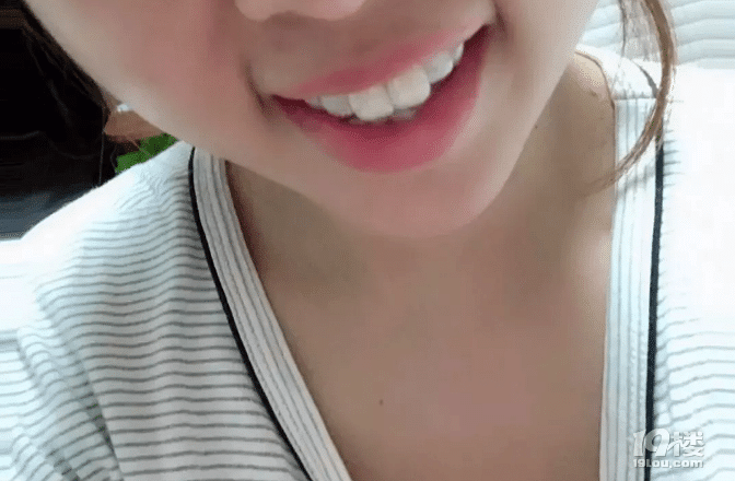 【隐形牙套日记】时代天使和隐适美的区别有多大？30岁女生侧颜杀