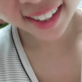 【隐形牙套日记】时代天使和隐适美的区别有多大？30岁女生侧颜杀_图5