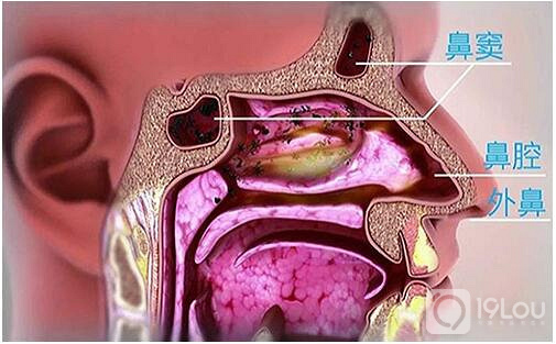 急性鼻窦炎和慢性鼻窦炎的症状有什么不同