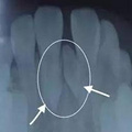 孩子有多生的牙齿，需要拔掉吗？_图4