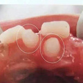 孩子有多生的牙齿，需要拔掉吗？_图1