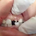 孩子有多生的牙齿，需要拔掉吗？_图2