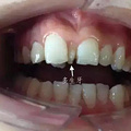 孩子有多生的牙齿，需要拔掉吗？_图0