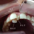 孩子有多生的牙齿，需要拔掉吗？_图3