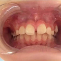 孩子有多生的牙齿，需要拔掉吗？_图5