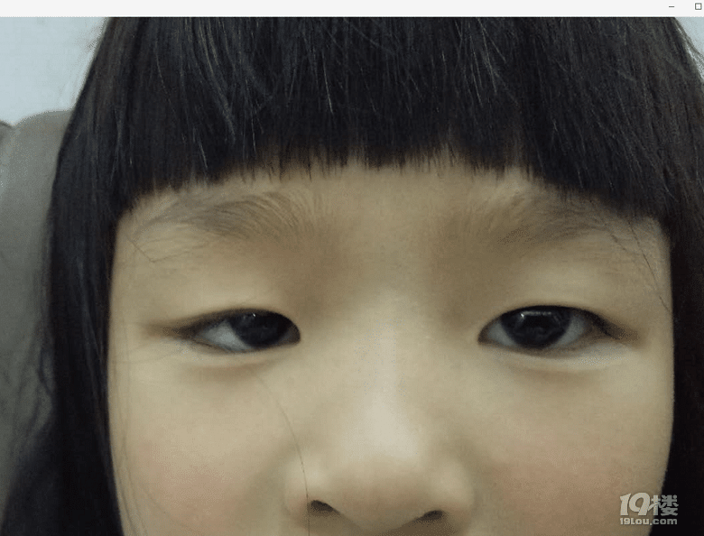 女儿6周岁了出生就眼睛一大一小是不是上眼睑下垂