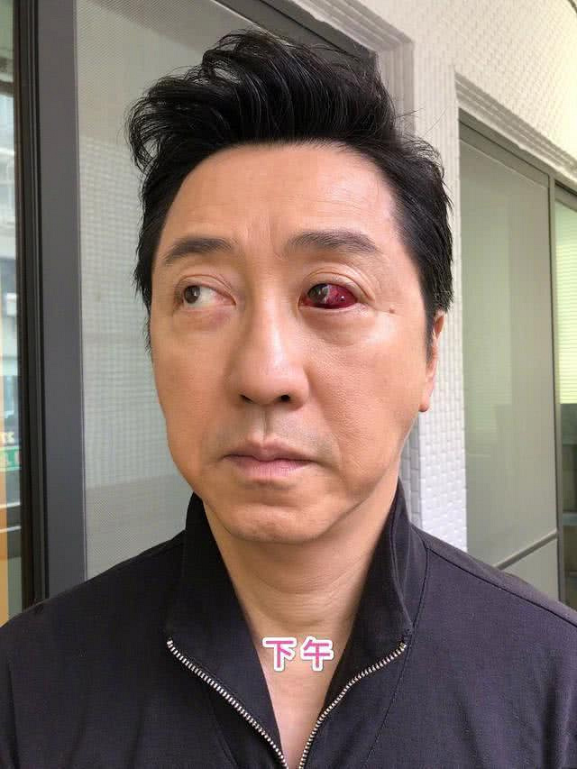 庾澄庆曝眼底充血原因,血管老化多次复发,未来