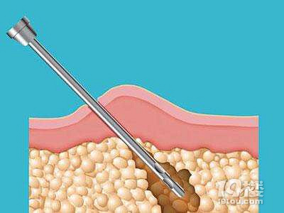 做腰部吸脂手术需要多少钱