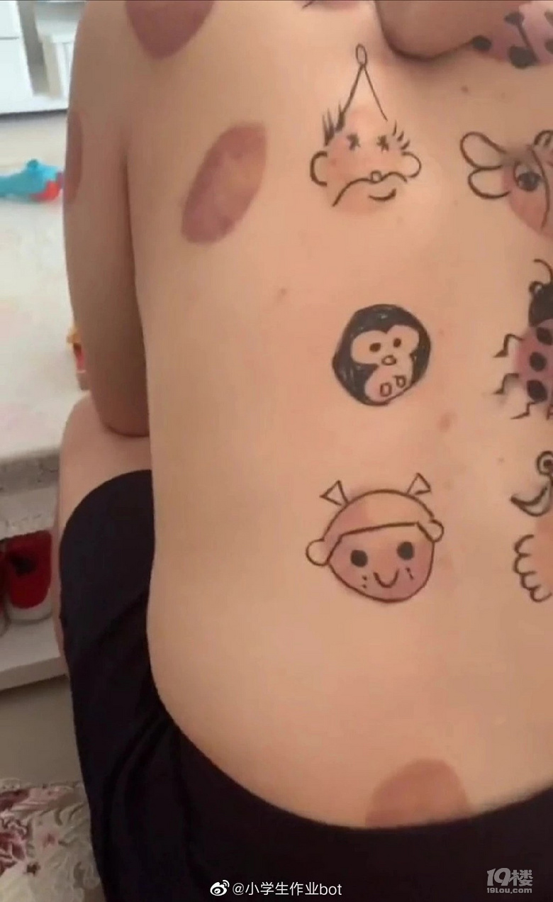 爸爸拔完火罐后的正确做法是…哈哈哈哈哈