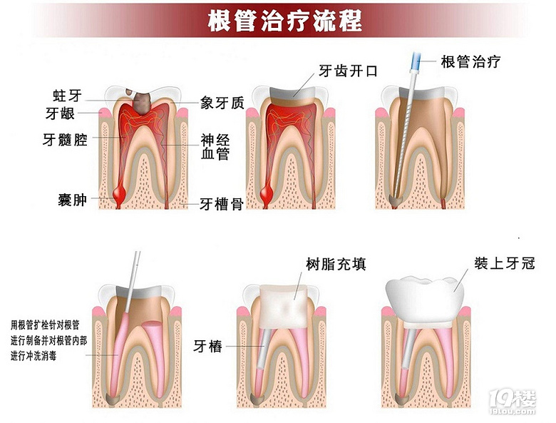 杭州做根管治疗后不戴冠可以吗？