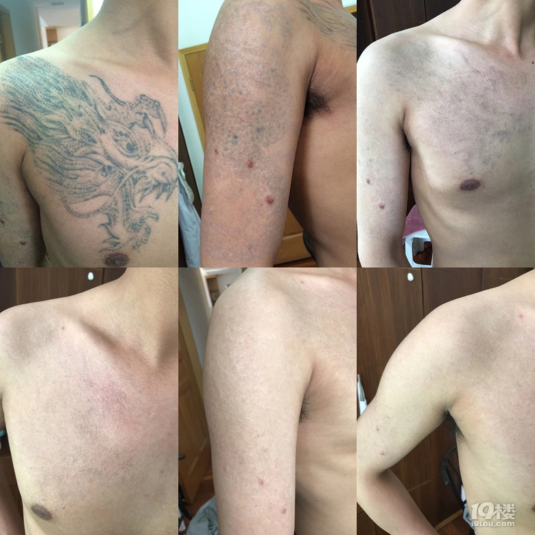 昆明李医生洗纹身---无痛洗纹身洗眉胎记！
