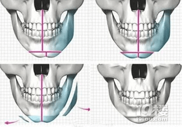 杭州时光美容医院-下巴整形术有哪些方法?下巴