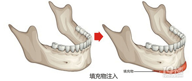 杭州时光美容医院-下巴整形术有哪些方法?下巴