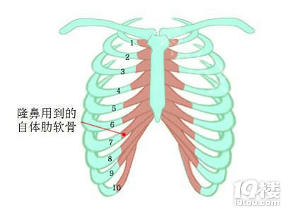 整形医生胡斌-肋软骨隆鼻10个常见问题解答
