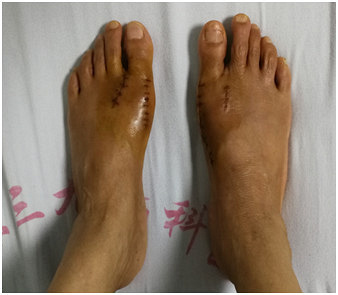 年轻时爱穿高跟鞋,如今她不得不截骨!女孩特别留意