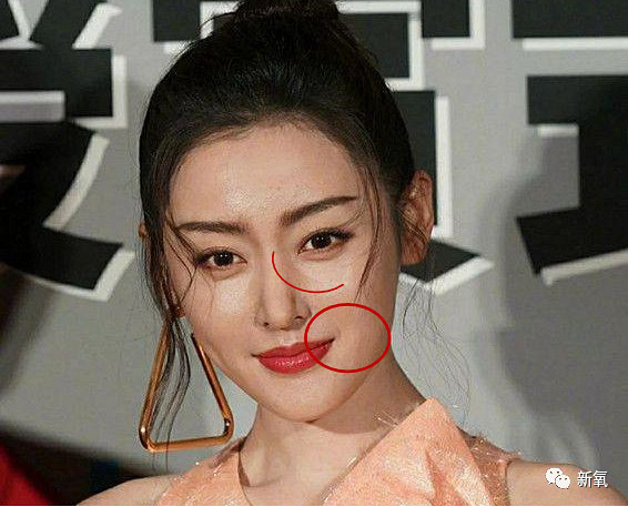 眼窝凹陷,泪沟,木偶