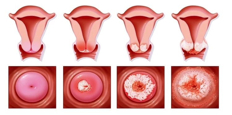 宫颈癌病变过程图片图片