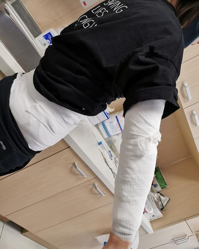 邓莎拔火罐烧伤背部不算啥,齐秦曾因拔火罐被烧得脸上布满了绷带