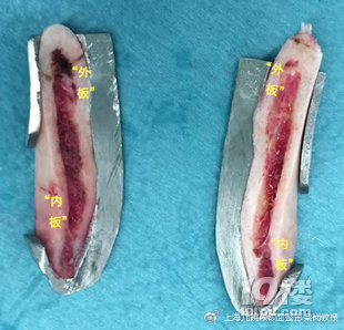 內(nèi)板?外板?下頜角手術(shù)到底弄的是什么板