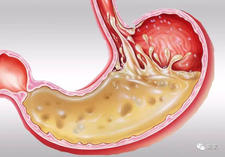 继宋祖儿催吐疤之后,22岁女孩为催吐把胃管吞入腹中