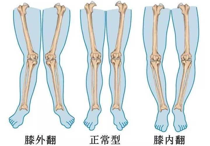 孩子x,o型腿,只因爸媽忽略了這些!