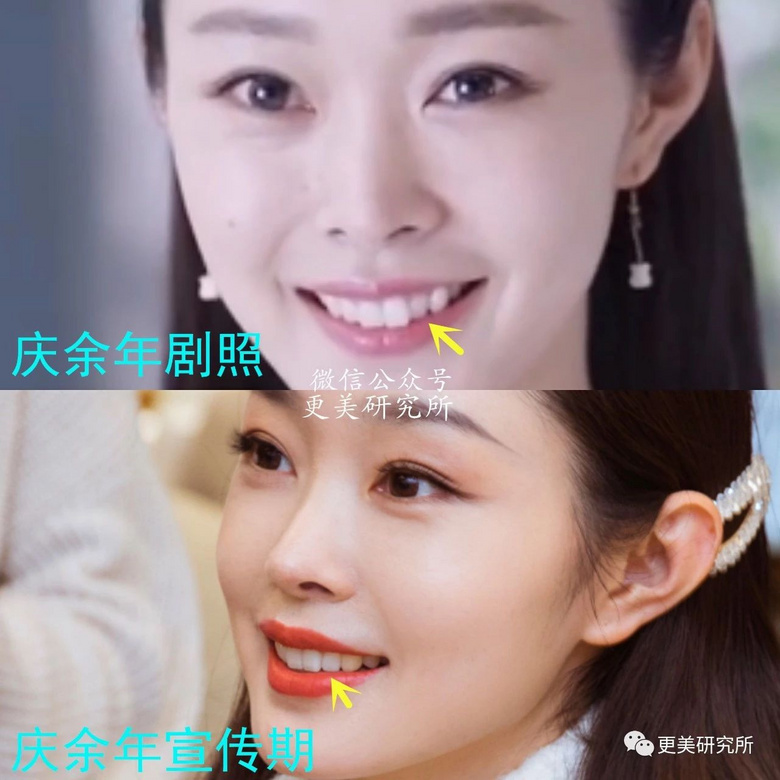 爆红30天后宋轶就去整了,怎么灵气就变了?-整容日记-杭州19楼