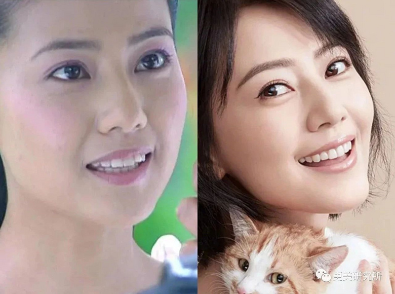 爆红30天后宋轶就去整了,怎么灵气就变了?-整容日记-杭州19楼