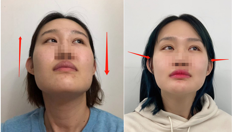 杭州19楼 爱美丽 整容日记 长腿妹因鞋拔子脸被认成男.65