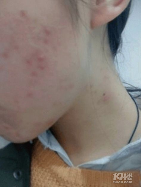 章夏手记-一入祛痘深似海,从此钱包是路人