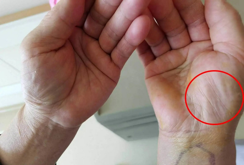 林女士自己都没发现, 她的右手掌本该"肉嘟嘟"的大鱼际肌整块"瘪"了