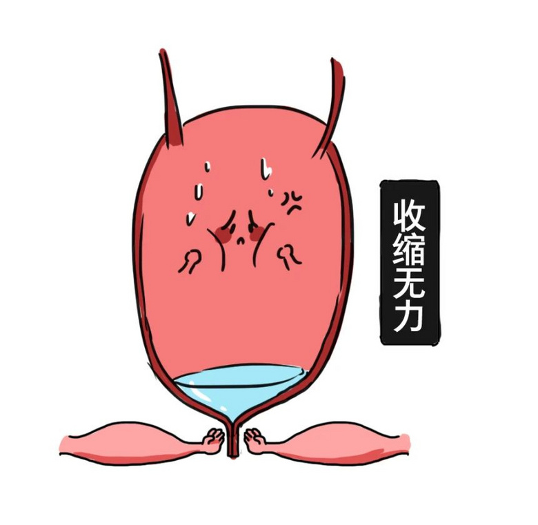 憋住的尿,都去哪了?